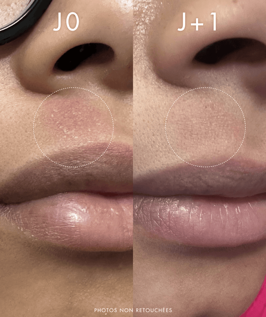 résultat avant après soin omoyé rougeurs apaisées peau hydratée visible en 1 jour sans retouche homme femme